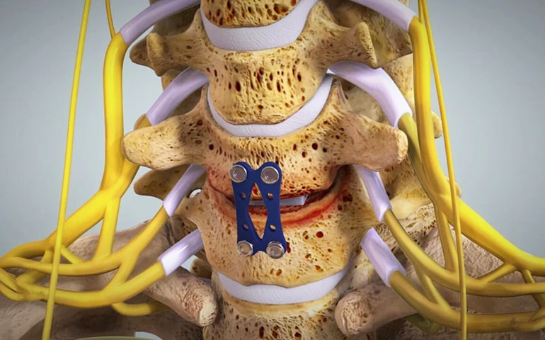 Anterior Cervical Discectomy And Fusion (ACDF) – Visit the Best ...