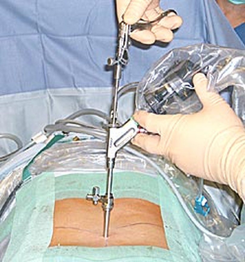 Open surgical field with instruments in place